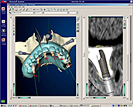 インプラント植立診断用ソフト