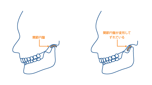 固い もの を 噛む と 歯 が 痛い